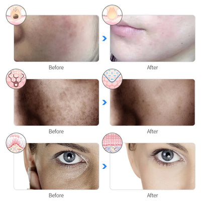 Skin Rejuvenation Home Facial LED Mask